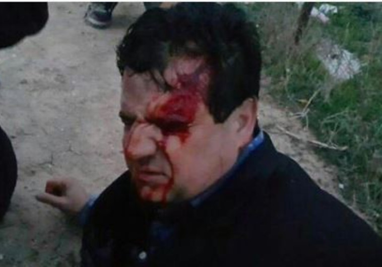 ח&quot;כ איימן עודה לאחר שנפצע בעימותים חיראן