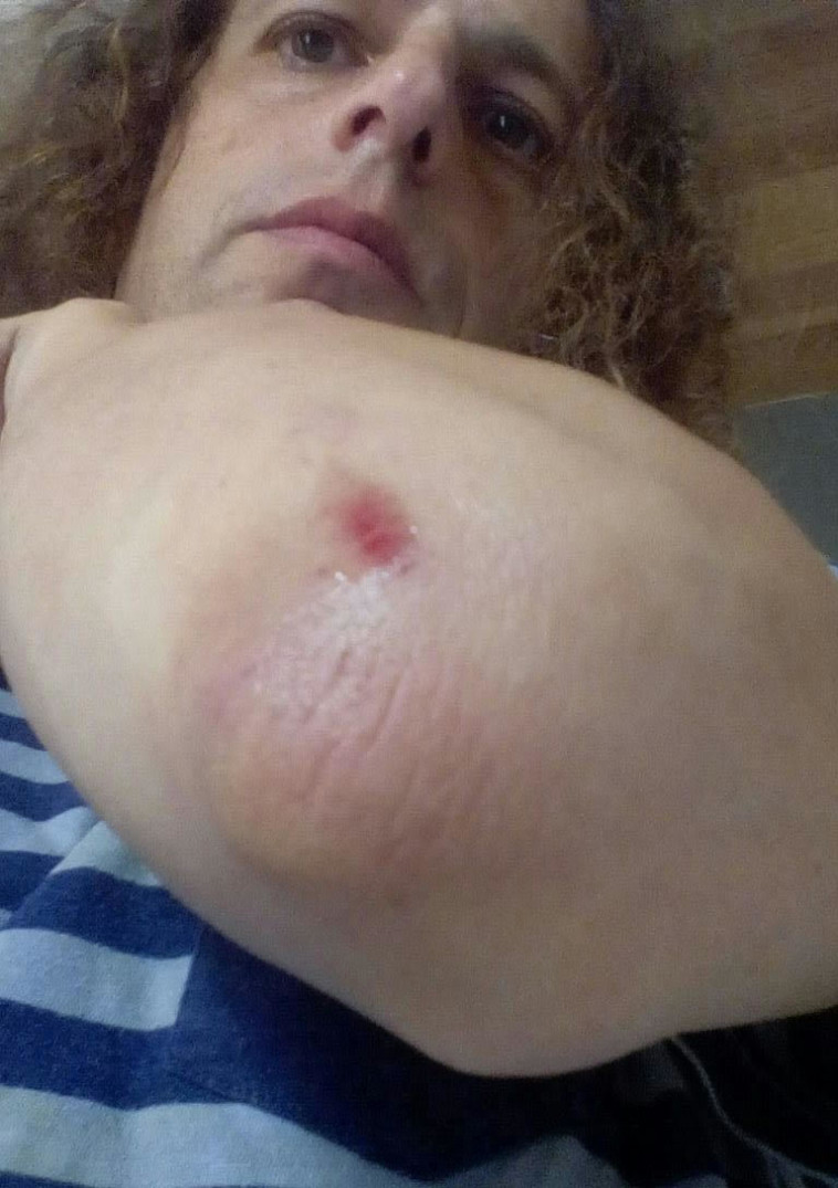 הפציעה מהמריבה עם נופי