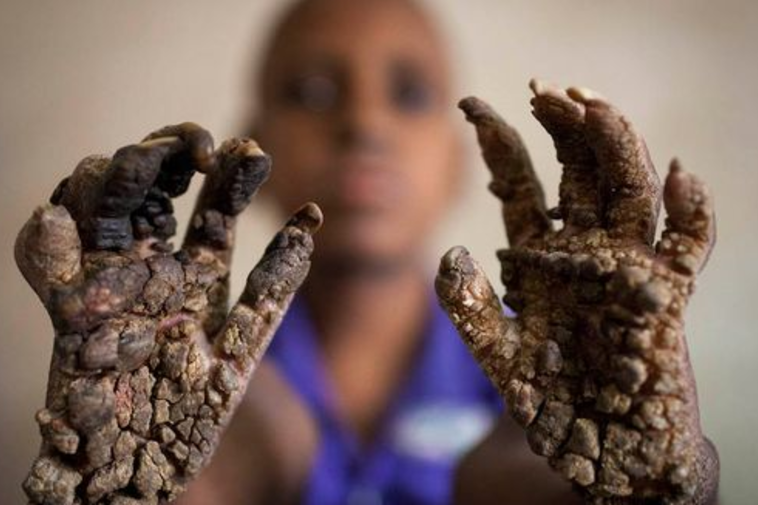 סובל ממחלה נדירה. צילום: מתוך אתר המירור