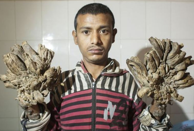 אבול באג'אנדר. יצטרך לעבור עוד לפחות 15 ניתוחים. צילום: מתוך אתר המירור