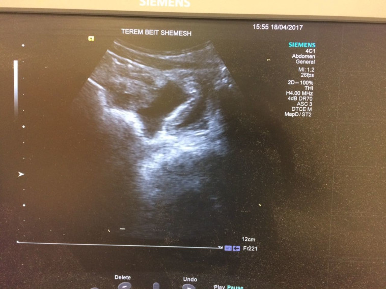&quot;האבחון המהיר הציל את חייו של הילד&quot;. בדיקת האולטרה סאונד. צילום: מוקד טרם