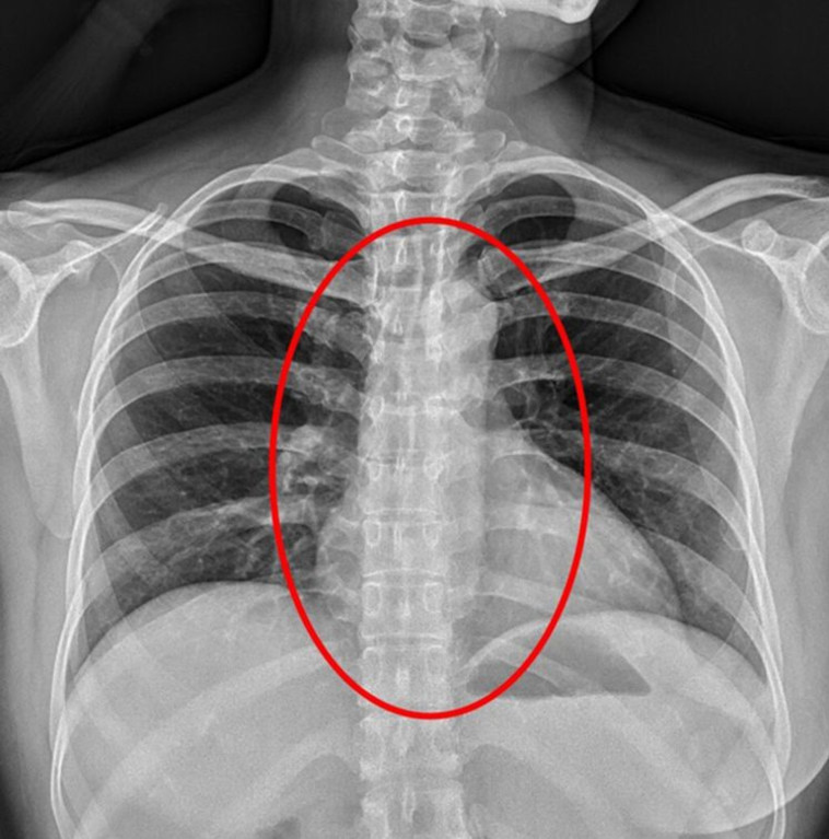 הצל שנמצא בצילומי הרנטגן של היצאנית. צילום מסך