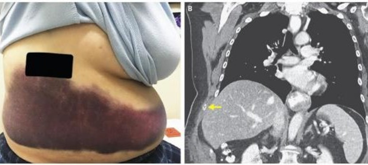  the New England Journal of Medicine :השתעלה ושברה לעצמה צלע. צילום