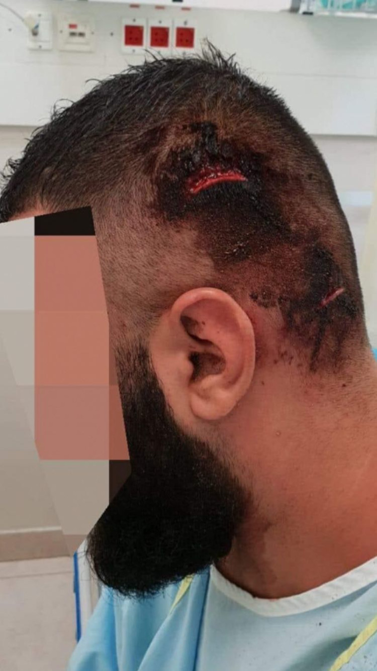 תושב שפרעם שהותקף תושב שפרעם שהותקף