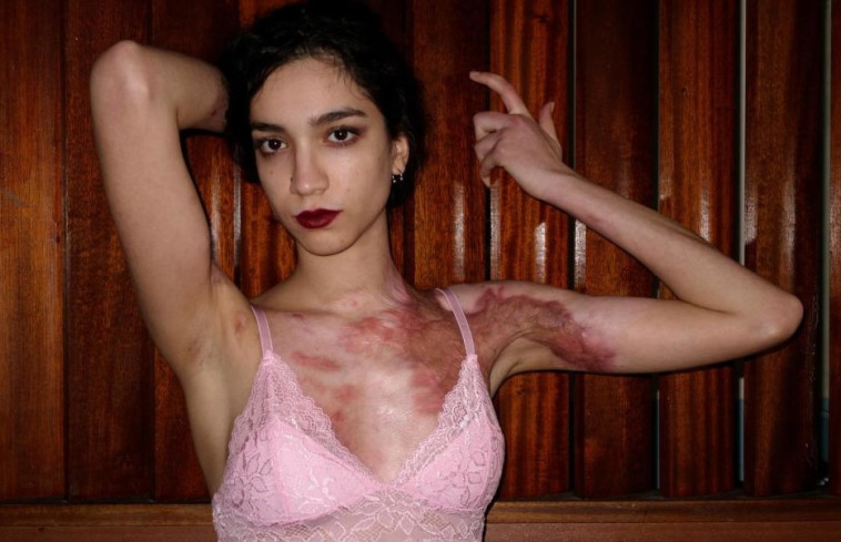 כבר לא חושבת שהצלקות מכוערות. סוניה קופר, צילום מסך