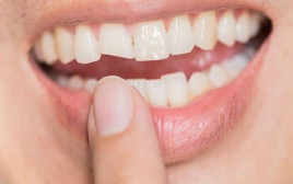 שיניים (צילום: שאטרסטוק)