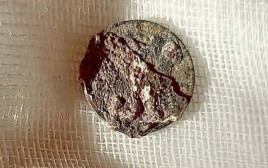 המטבע שנמצא בתוך אפו של המטופל (צילום: City Clinical Hospital named after M. Konchalovsky)