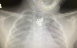 צילום הרנטגן של בת ה-3 (צילום: המרכז הרפואי קפלן)