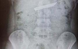 צילום רנטגן, בו ניתן לראות את להב הסכין בבטן העליונה  (צילום: דוברות המרכז הרפואי לגליל)