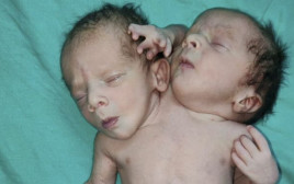 זוג התאומים התגלה כתינוק אחד עם שני ראשים ושלוש זרועות (צילום: Ratlam hospital)