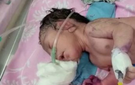  תינוק נולד בהודו עם מבנה דמוי קרן במקום רגליים (צילום: מתוך פייסבוק)