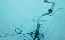 צילום הדמיה, בו ניתן לראות את החסימה באחד מעורקיה המוח (צילום: המרכז הרפואי לגליל)