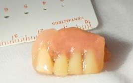 פלטת תותבת השיניים של הגבר בשנות ה-50 לחייו (צילום: דוברות מרכז רפואי "מאיר" מקבוצת "כללית")