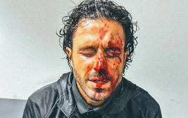 פאביו גרוסו מאמן ליון לאחר שנפצע מבלוקים שנזרקו על האוטובוס מצד אוהדי מארסיי (צילום: צילום מסך, מתוך טוויטר)