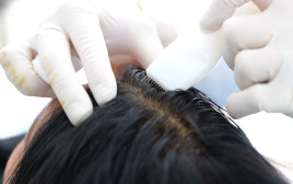 הזרקת שיער סינטטי בקרקפת  (צילום: היירסטטיקס)