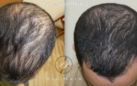 הקרב על השיער (צילום: BioHair )