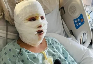 צעירה בת 19 כמעט נשרפה למוות (צילום: HotSpot Media)