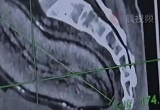 תפוח אדמה בבטנו של הגבר (צילום: רשתות חברתיות)