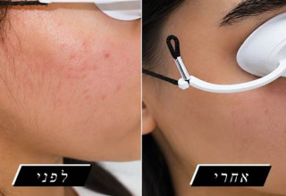 הטכנולוגיה שכובשת את עולם הסרת השיער הגיעה ללוד (צילום: יחצ)