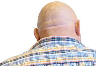 קרחת (צילום: אינג אימג')