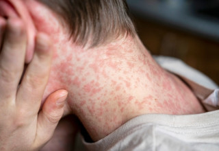 סימפטומים דמויי שפעת ותגובה מוחית. הטיפול כולל תרופות נוגדות אלרגיה (צילום: שאטרסטוק)