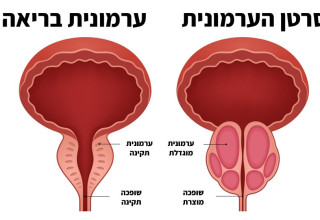 סרטן ערמונית (צילום: איור: מעריב אונליין)