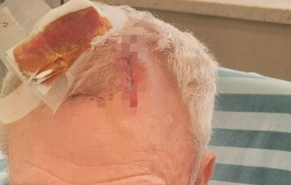 בן ה-73 שהותקף בבקבוק זכוכית על ידי רוכב אופנוע (צילום: דוברות המשטרה)