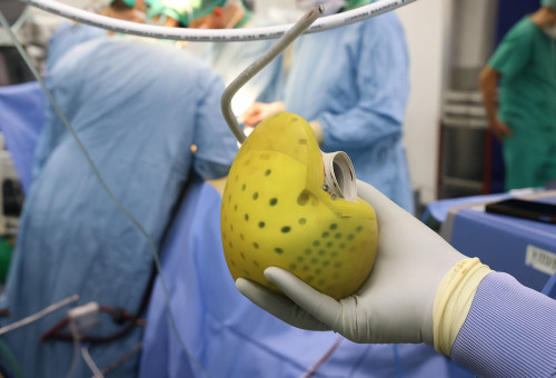 השתלת לב אנושי (צילום: יחידת הצילום, שיבא)