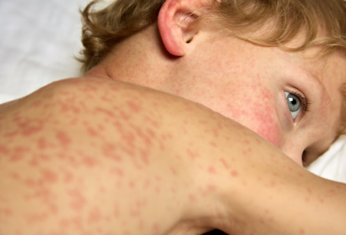 חצבת (צילום: שאטרסטוק)