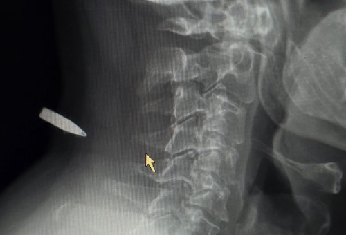 צילום הרנטגן של הכדור שנתקע בצווארו (צילום: באדיבות המצולם)