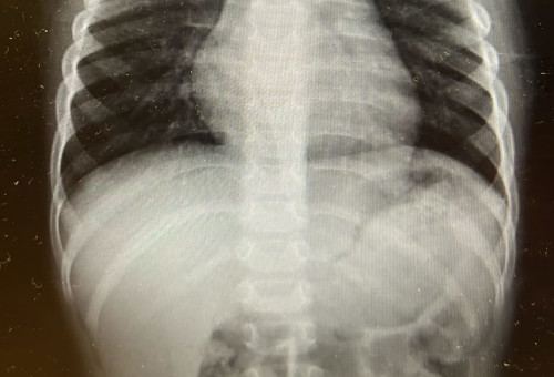 צילום רנטגן של בית החזה של הילד (צילום: דוברות מרכז רפואי "מאיר" מקבוצת "כללית")