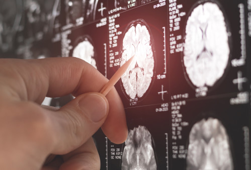 סריקת מוח, MRI, אילוסטרציה (צילום: שאטרסטוק)