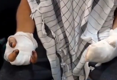 אחד הנפגעים במבצע הביפרים (צילום: רשתות ערביות)