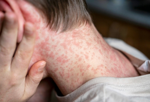 סימפטומים דמויי שפעת ותגובה מוחית. הטיפול כולל תרופות נוגדות אלרגיה (צילום: שאטרסטוק)