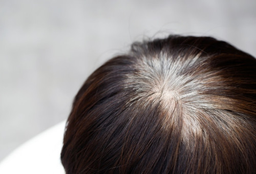 שיער לבן. פגיעה במלנוציטים (צילום: שאטרסטוק)