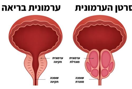 סרטן ערמונית (צילום: איור: מעריב אונליין)
