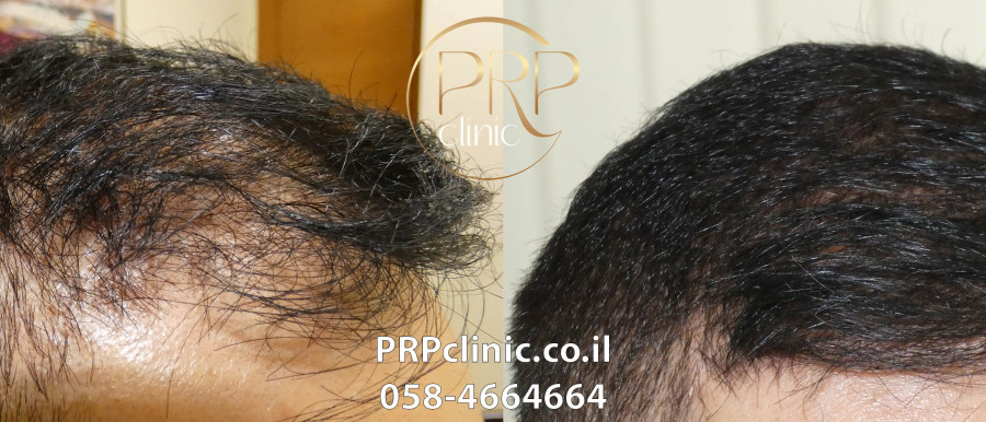 הקרב על השיער (צילום: PRPclinic)