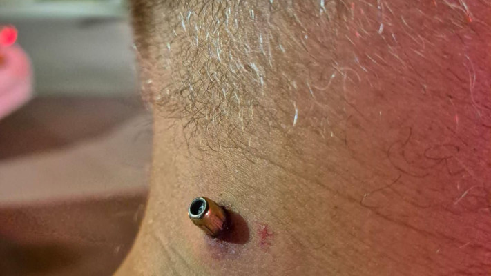 הכדור התקוע בצוואר