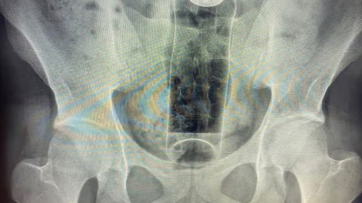 גבר הכניס דאודורנט לישבנו 