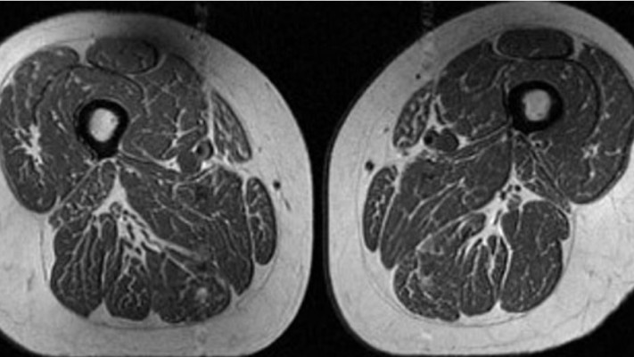 הדמיית ה-MRI של אחת המשתתפות. מרבצי שומן רבים בין סיבי השריר