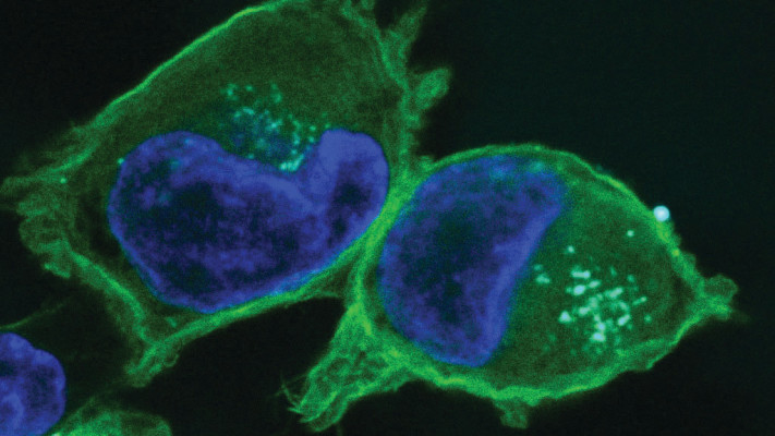 תאים נגועים בסרטן הלבלב (צילום: הדס גיבורי, אוניברסיטת תל אביב)