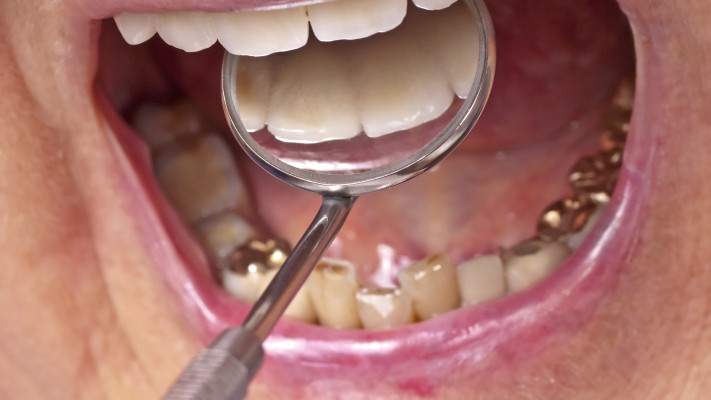 שיניים, אילוסטרציה (צילום: אינג'אימג')