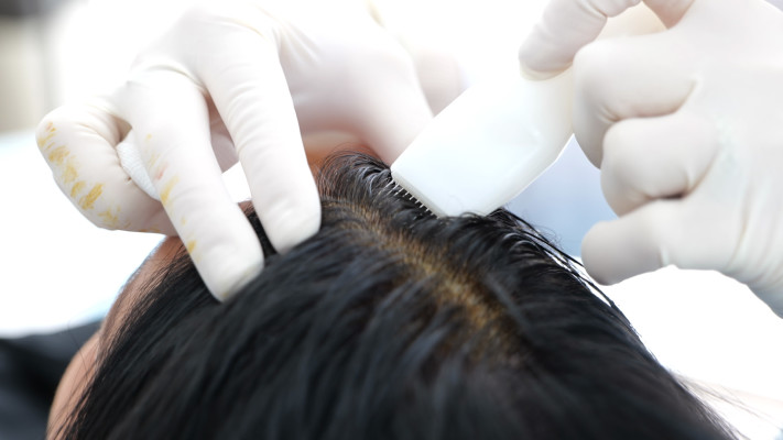 הזרקת שיער סינטטי בקרקפת 