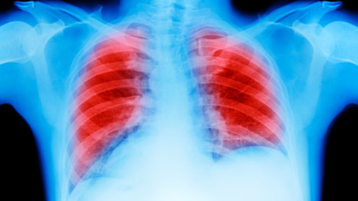  ''מטבע הדברים עישון הוא גורם הסיכון העיקרי''