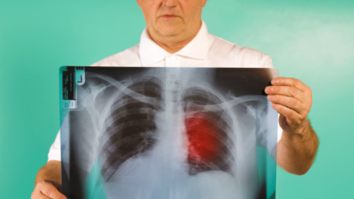  כ-2,700 ישראלים מאובחנים מדי שנה כחולים בסרטן הריאה