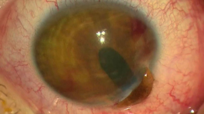 החתך בקרנית העין