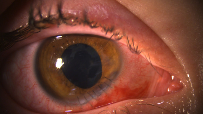 העין התפורה לאחר הניתוח 