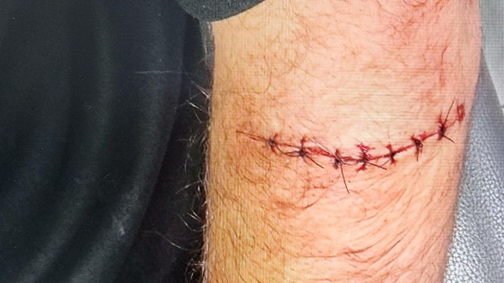 התפרים של הקורבן