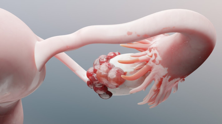 גידול סרטני על שחלה. הסימנים מופיעים באיחור