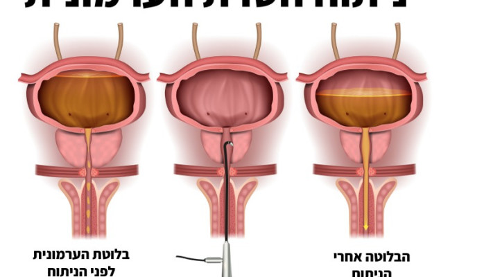 ערמונית מוגדלת. קושי במתן שתן  (צילום: שאטרסטוק)